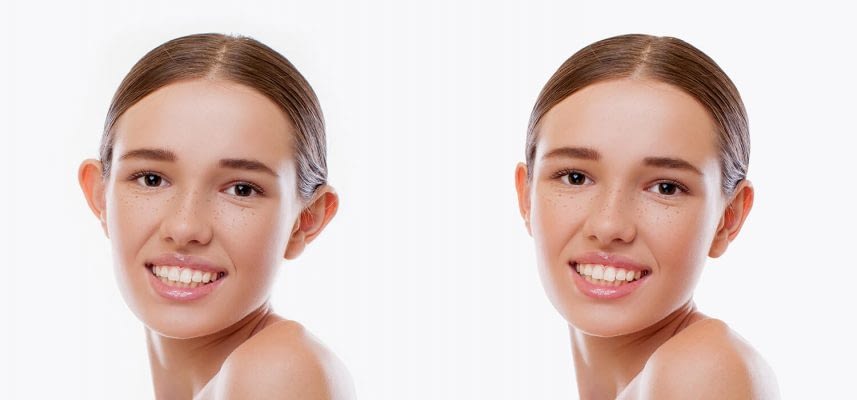 otoplastia-pelo-SUS otoplastia-pelo-SUS