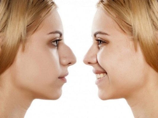 3uArorinoplastia_e0d79f75d7e62e7b67a8912ed2b3cb5f61538593 3uArorinoplastia_e0d79f75d7e62e7b67a8912ed2b3cb5f61538593