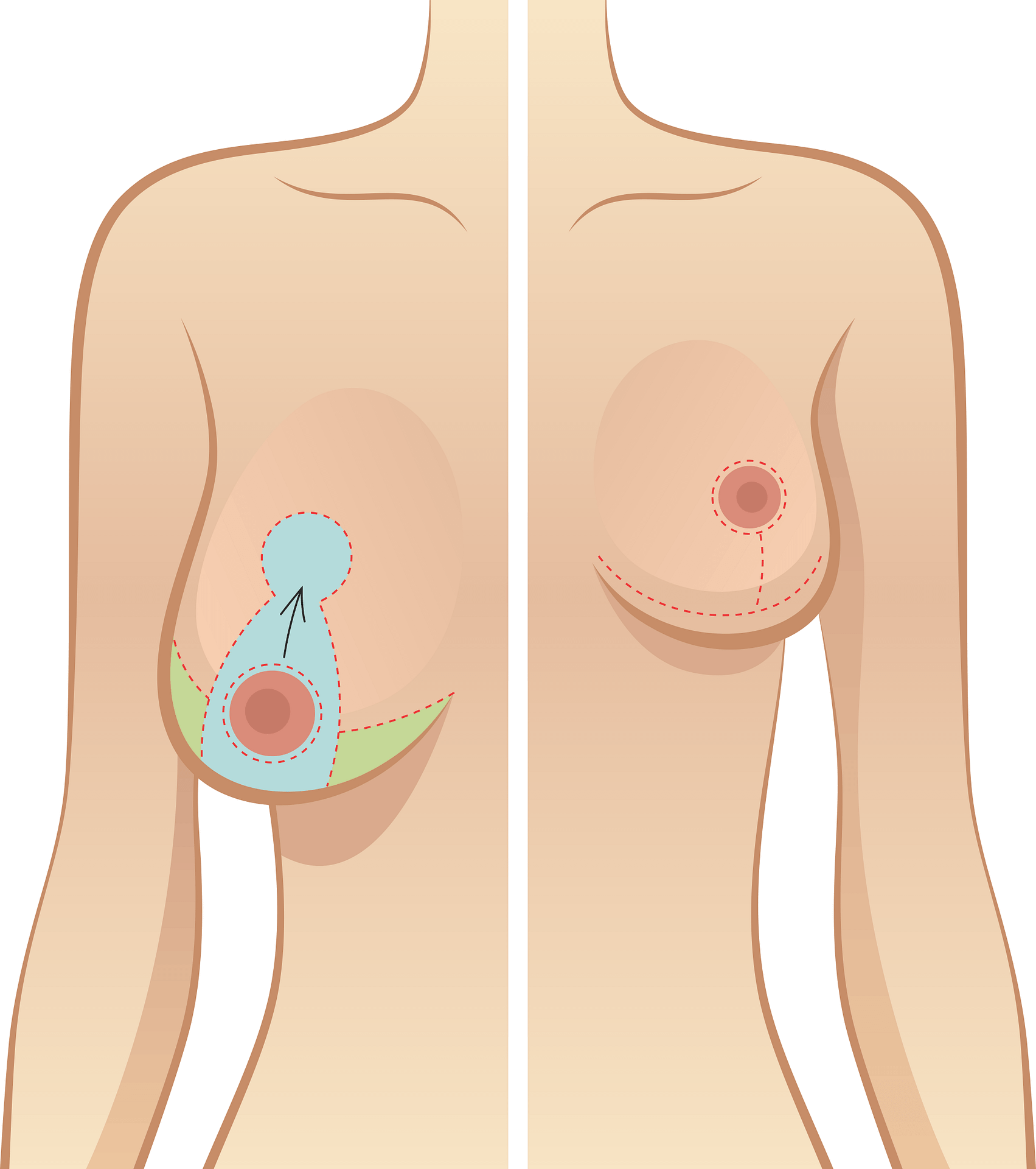 mamoplastia-de-redução