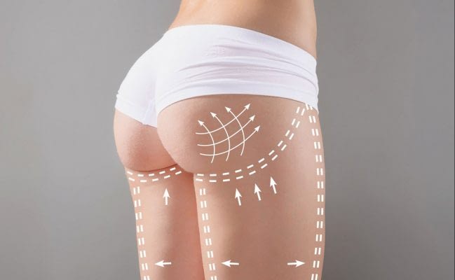 gluteoplastia-120619 gluteoplastia-120619